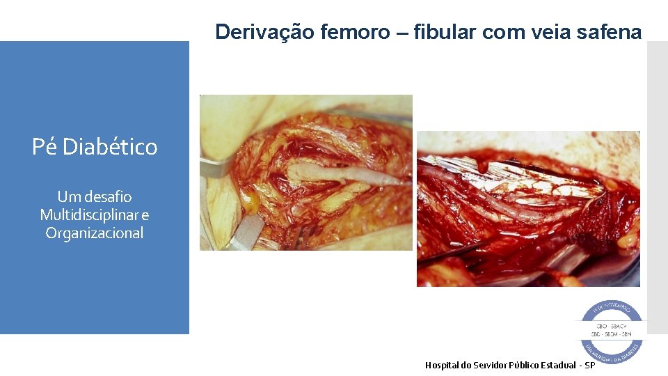 Derivação femoro – fibular com veia safena Pé Diabético Um desafio Multidisciplinar e Organizacional