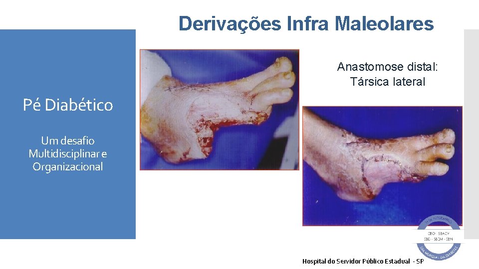 Derivações Infra Maleolares Anastomose distal: Társica lateral Pé Diabético Um desafio Multidisciplinar e Organizacional