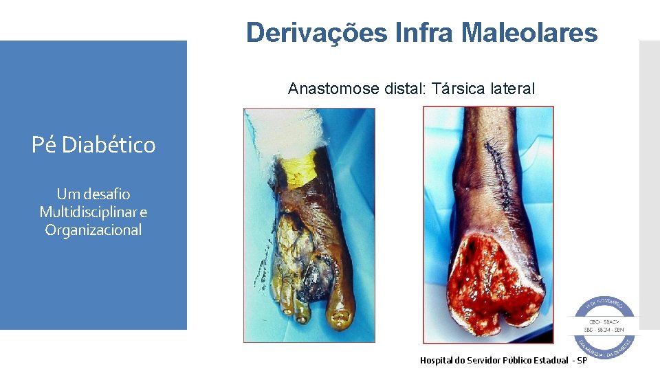 Derivações Infra Maleolares Anastomose distal: Társica lateral Pé Diabético Um desafio Multidisciplinar e Organizacional