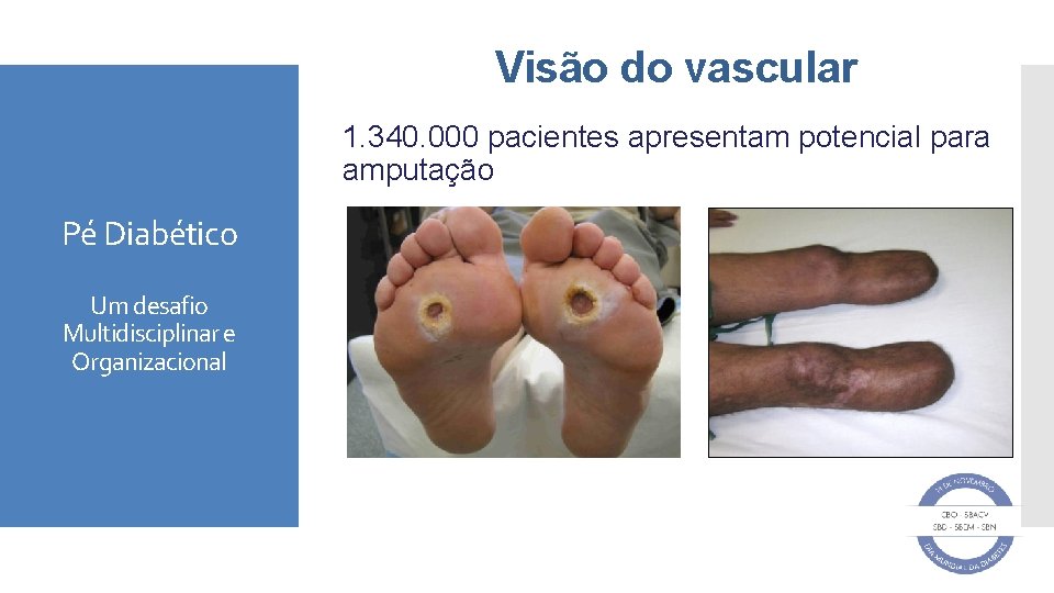 Visão do vascular 1. 340. 000 pacientes apresentam potencial para amputação Pé Diabético Um