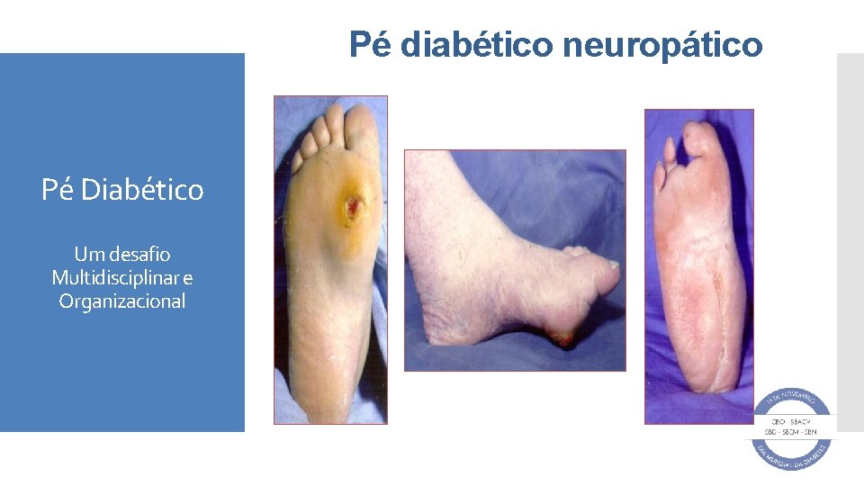 Pé diabético neuropático Pé Diabético Um desafio Multidisciplinar e Organizacional 