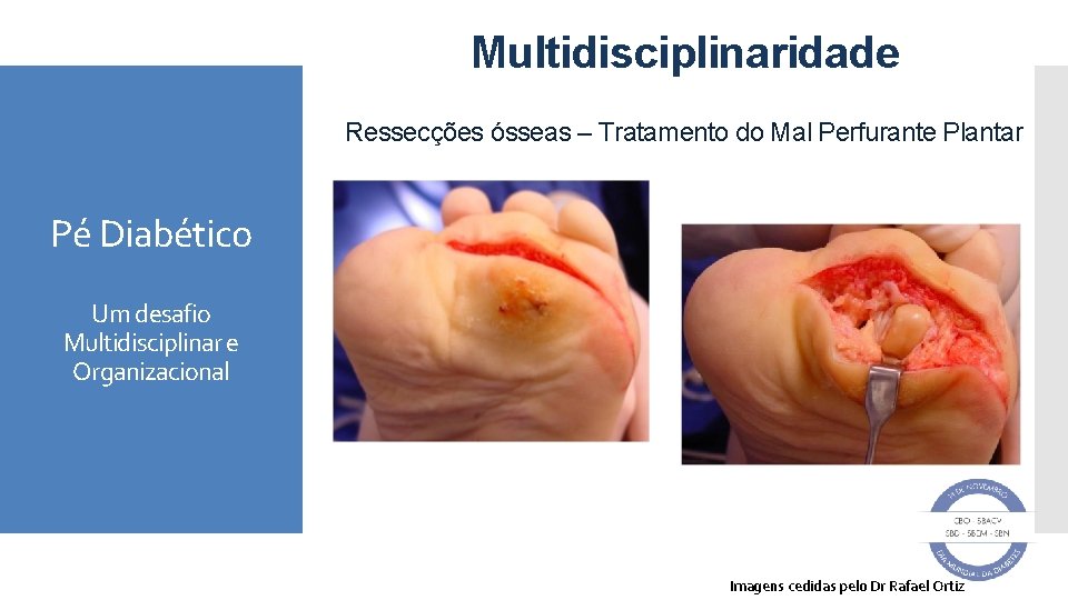 Multidisciplinaridade Ressecções ósseas – Tratamento do Mal Perfurante Plantar Pé Diabético Um desafio Multidisciplinar