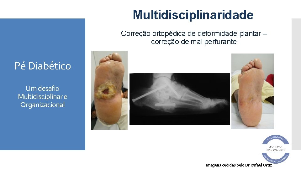 Multidisciplinaridade Correção ortopédica de deformidade plantar – correção de mal perfurante Pé Diabético Um