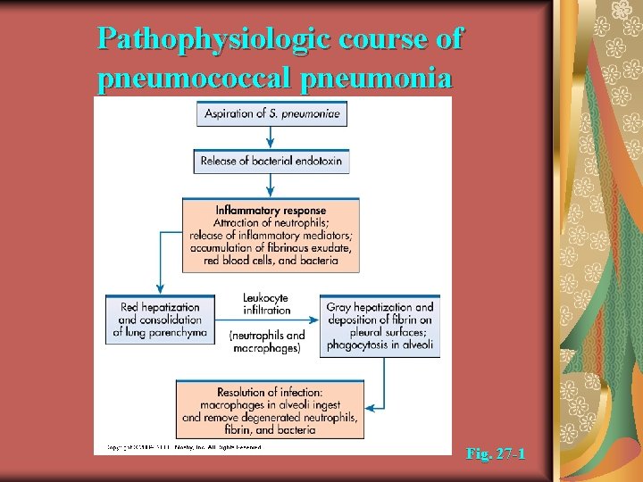 Pathophysiologic course of pneumococcal pneumonia Fig. 27 -1 
