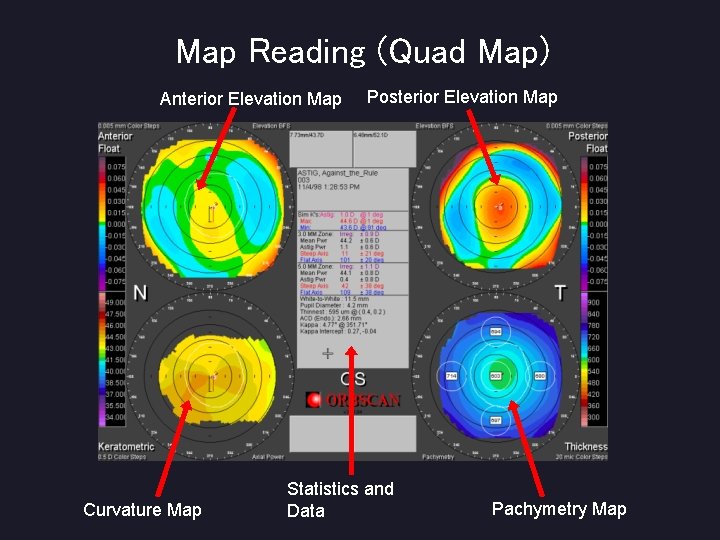 Map Reading (Quad Map) Anterior Elevation Map Curvature Map Posterior Elevation Map Statistics and