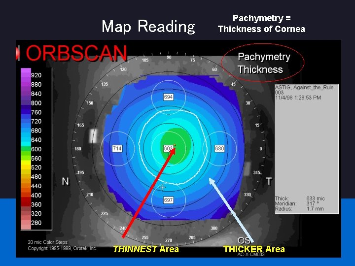 Map Reading THINNEST Area Pachymetry = Thickness of Cornea THICKER Area 