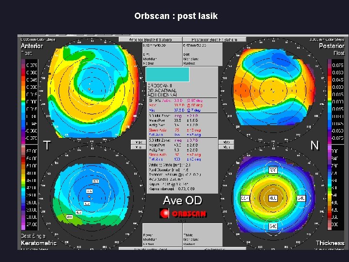 Orbscan : post lasik 