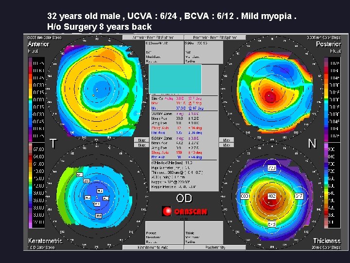 32 years old male , UCVA : 6/24 , BCVA : 6/12. Mild myopia.