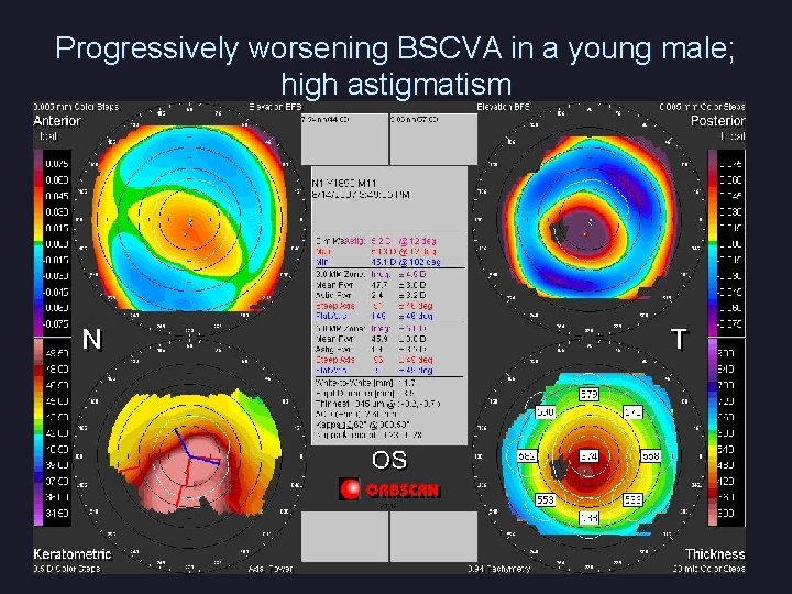 Progressively worsening BSCVA in a young male; high astigmatism 