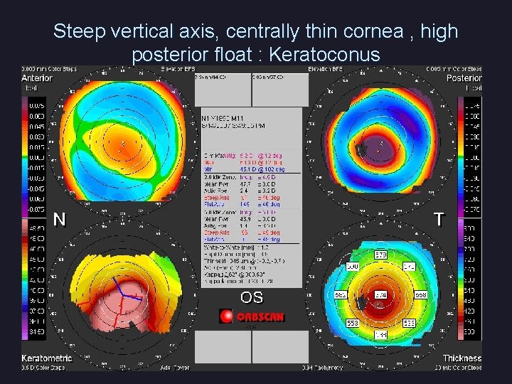 Steep vertical axis, centrally thin cornea , high posterior float : Keratoconus 