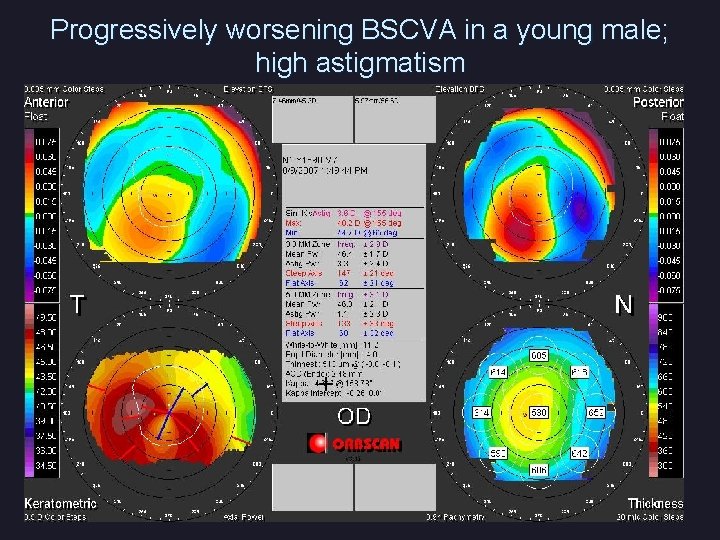 Progressively worsening BSCVA in a young male; high astigmatism 