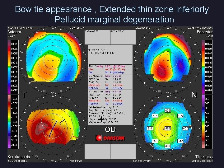 Bow tie appearance , Extended thin zone inferiorly : Pellucid marginal degeneration 