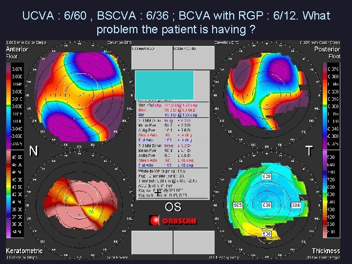 UCVA : 6/60 , BSCVA : 6/36 ; BCVA with RGP : 6/12. What