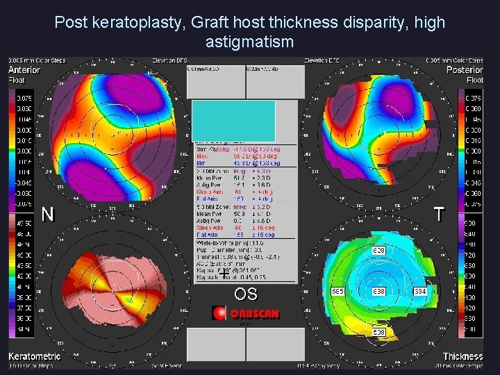 Post keratoplasty, Graft host thickness disparity, high astigmatism 