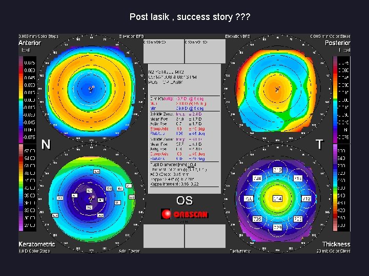 Post lasik , success story ? ? ? 