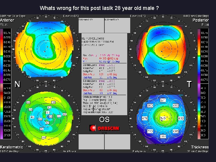 Whats wrong for this post lasik 28 year old male ? 