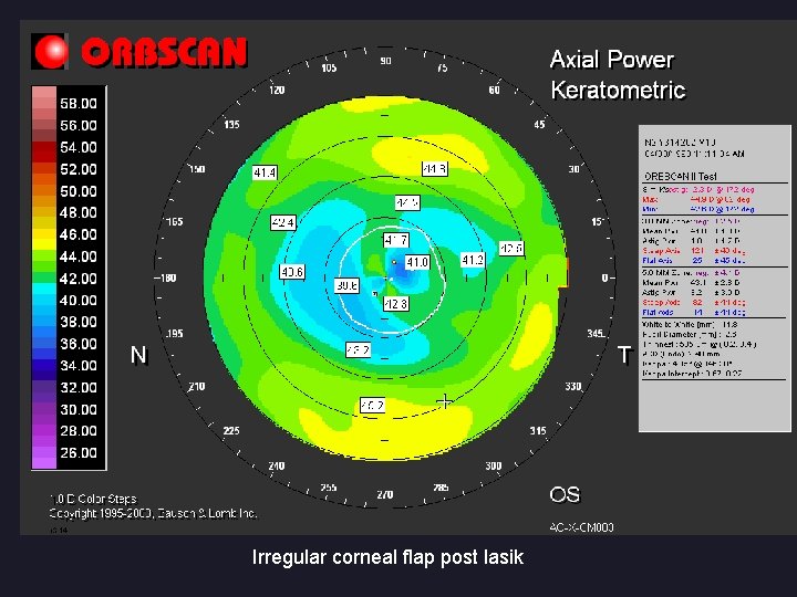 Irregular corneal flap post lasik 