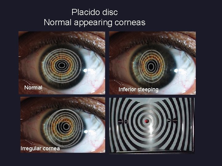 Placido disc Normal appearing corneas Normal Irregular cornea Inferior steeping 