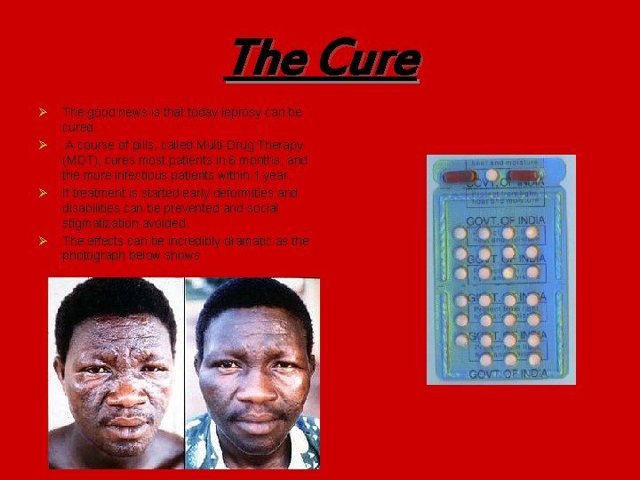 The Cure Ø Ø The good news is that today leprosy can be cured.
