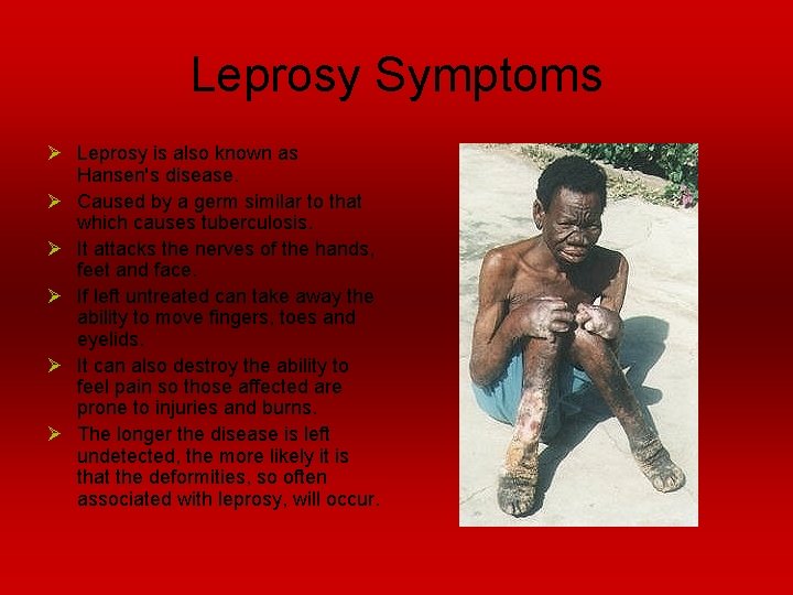 Leprosy Symptoms Ø Leprosy is also known as Hansen's disease. Ø Caused by a
