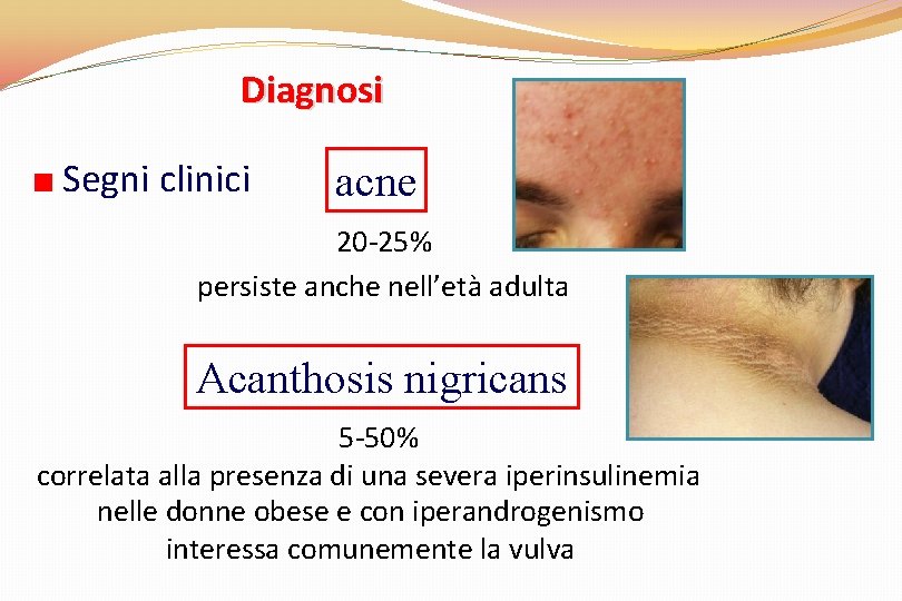 Diagnosi Segni clinici acne 20 -25% persiste anche nell’età adulta Acanthosis nigricans 5 -50%