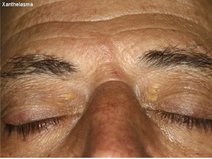 Xanthelasma 