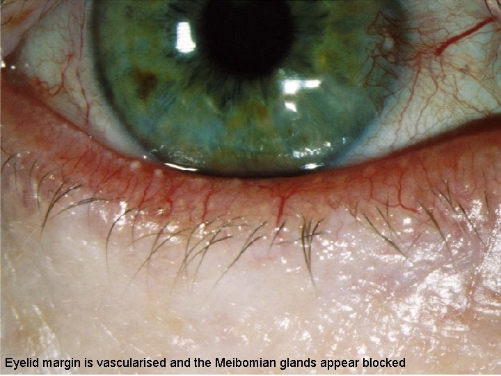 Eyelid margin is vascularised and the Meibomian glands appear blocked 