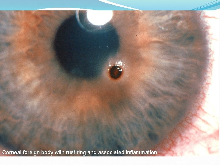 Corneal foreign body with rust ring and associated inflammation 