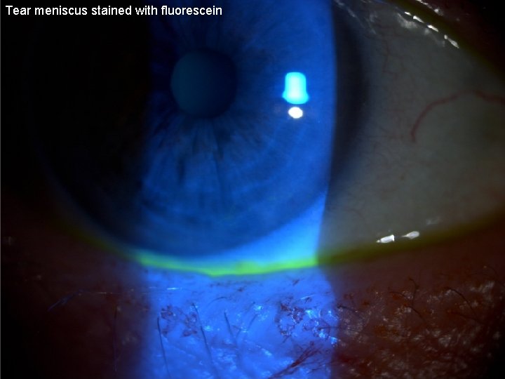 Tear meniscus stained with fluorescein 