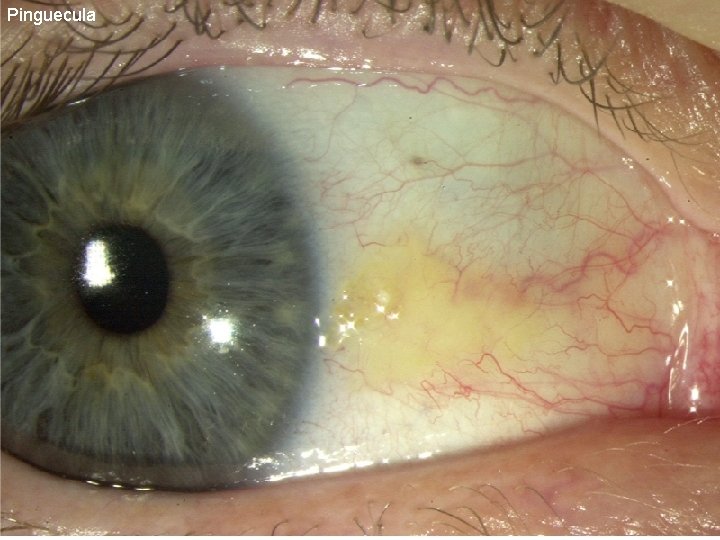 Pinguecula 