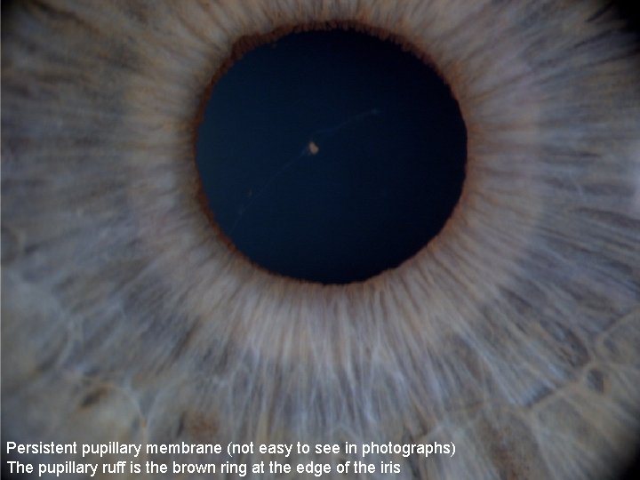 Persistent pupillary membrane (not easy to see in photographs) The pupillary ruff is the