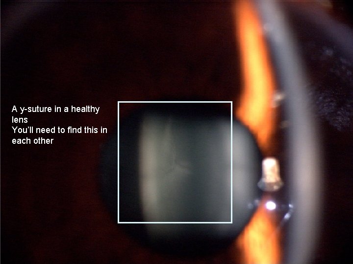 A y-suture in a healthy lens You’ll need to find this in each other