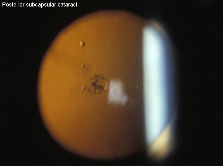 Posterior subcapsular cataract 