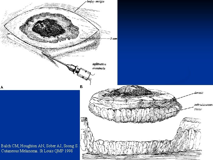 Balch CM, Houghton AN, Sober AJ, Soong S. Cutaneous Melanoma. St Louis QMP 1998
