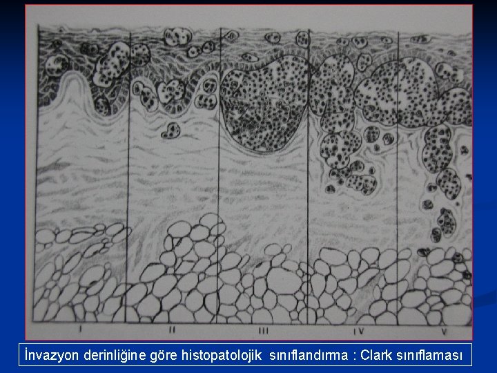 İnvazyon derinliğine göre histopatolojik sınıflandırma : Clark sınıflaması 