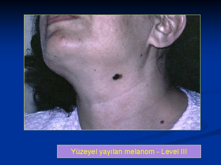 Yüzeyel yayılan melanom - Level III 