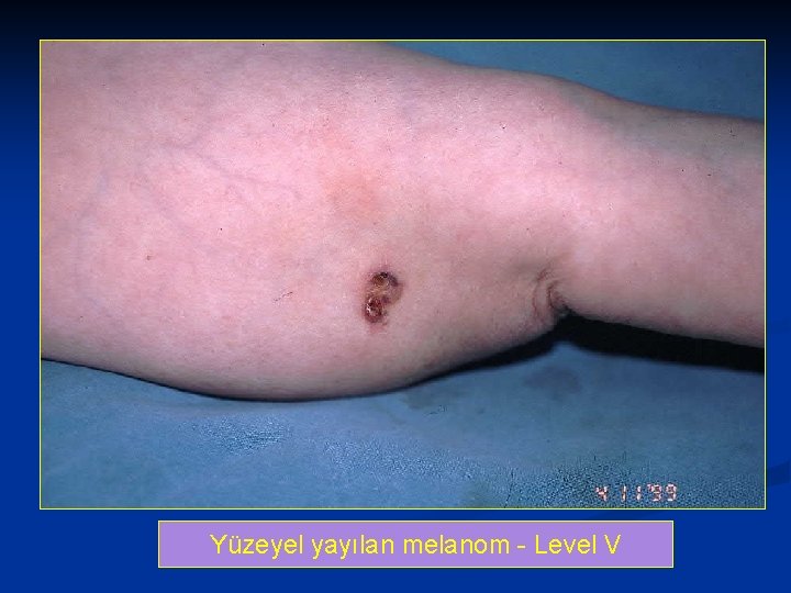 Yüzeyel yayılan melanom - Level V 