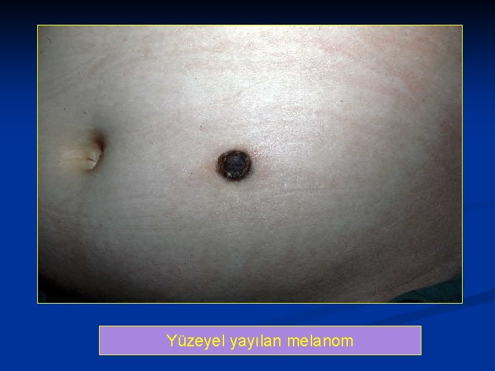 Superficial Yüzeyel yayılan spreading melanoma 