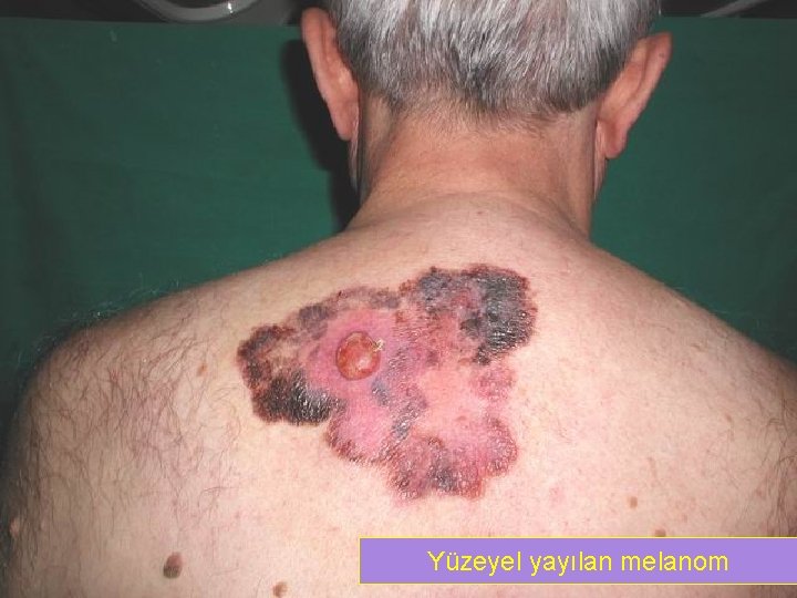 Yüzeyel yayılan melanom 