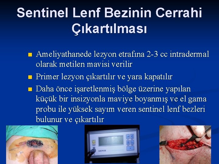 Sentinel Lenf Bezinin Cerrahi Çıkartılması n n n Ameliyathanede lezyon etrafına 2 -3 cc