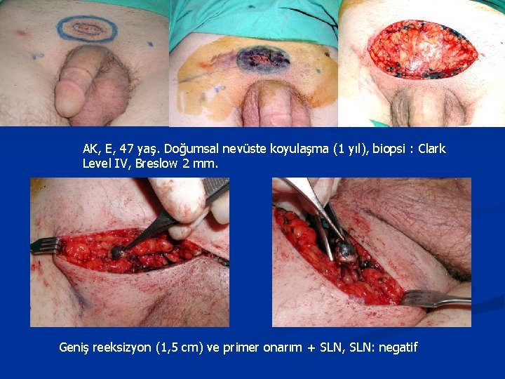 AK, E, 47 yaş. Doğumsal nevüste koyulaşma (1 yıl), biopsi : Clark Level IV,