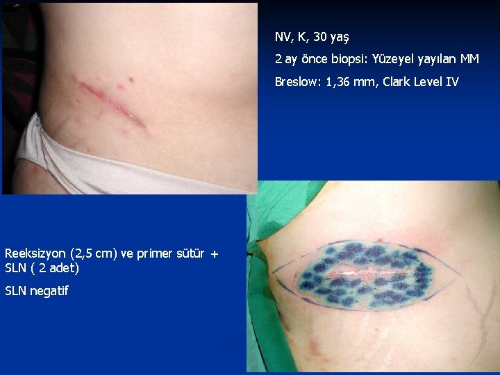 NV, K, 30 yaş 2 ay önce biopsi: Yüzeyel yayılan MM Breslow: 1, 36