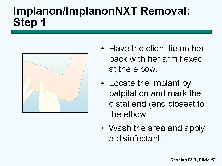 Implanon/Implanon. NXT Removal: Step 1 • Have the client lie on her back with