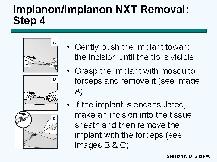 Implanon/Implanon NXT Removal: Step 4 A B C • Gently push the implant toward