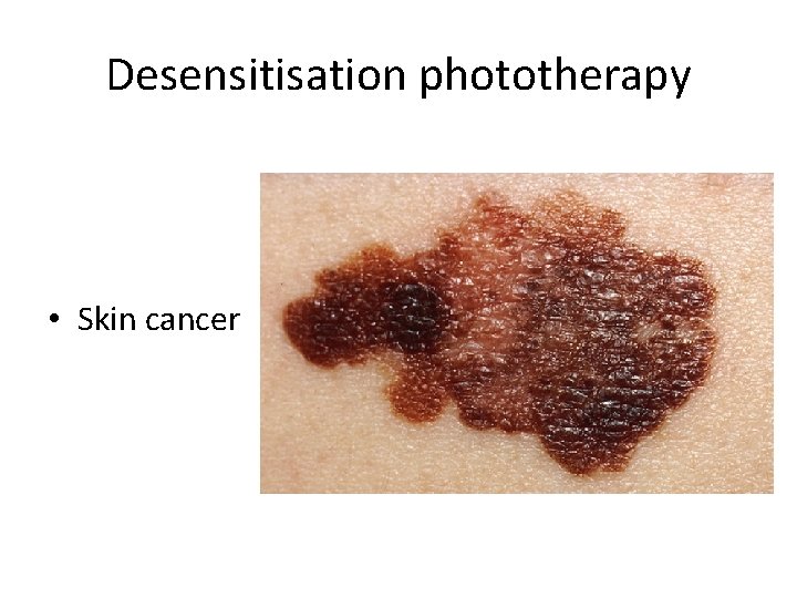 Desensitisation phototherapy • Skin cancer 