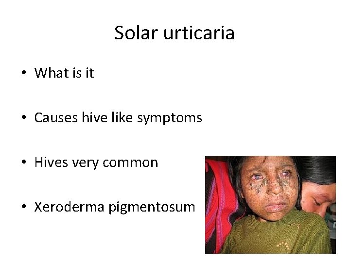 Solar urticaria • What is it • Causes hive like symptoms • Hives very