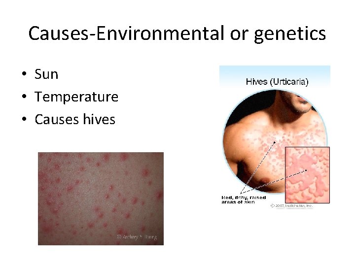 Causes-Environmental or genetics • Sun • Temperature • Causes hives 