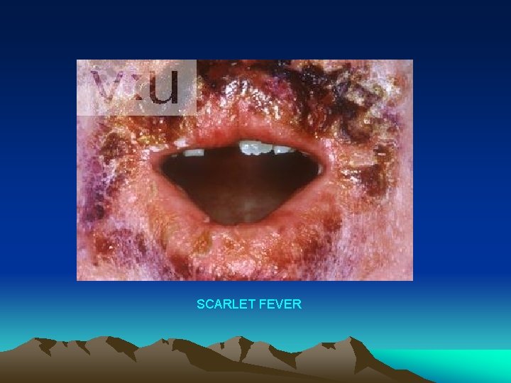 SCARLET FEVER 