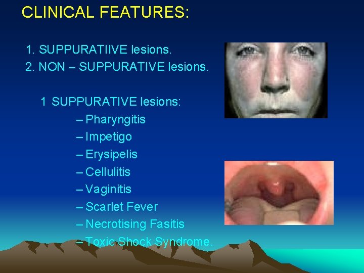 CLINICAL FEATURES: 1. SUPPURATIIVE lesions. 2. NON – SUPPURATIVE lesions. 1 SUPPURATIVE lesions: –