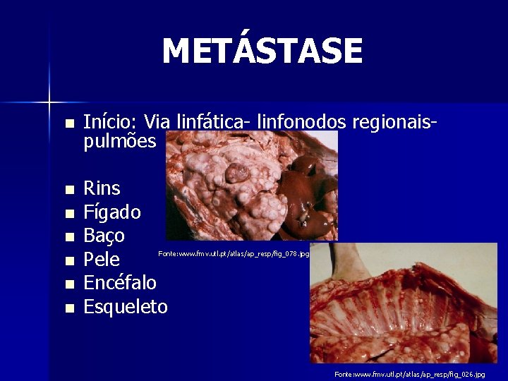 METÁSTASE n Início: Via linfática- linfonodos regionaispulmões n Rins Fígado Baço Pele Encéfalo Esqueleto